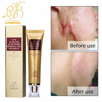 LANBENA ginseng extract against black dots cream scar removal facial blackhead acne skin care treatment, bleaching cream 30ml